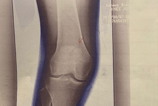 膝蓋骨骨折の症例と治療のご紹介。